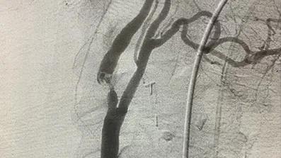 scan showing a blockage in an artery in the brain