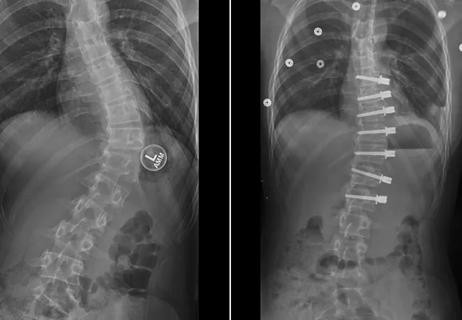 Vertebral body tethering to treat scoliosis