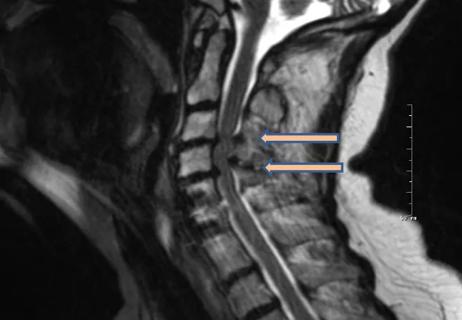 imaging study showing cervical spondylotic myelopathy in the neck