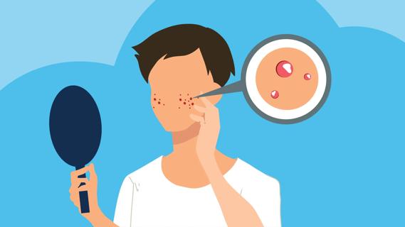 Person looking in a hand-held mirrro at pimple on their face, with close-up of pimples