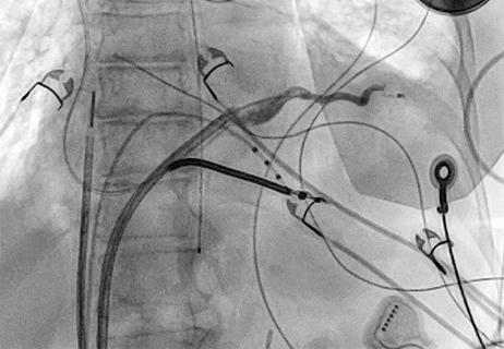 23-HVI-4298713-pericardial-CO2-insufflation-650&#215;450