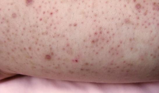Skin with red dots and bumps