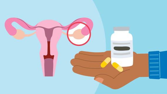 Hand holds bottle of yellow capsules, with anatomical uterus with ovaries circled