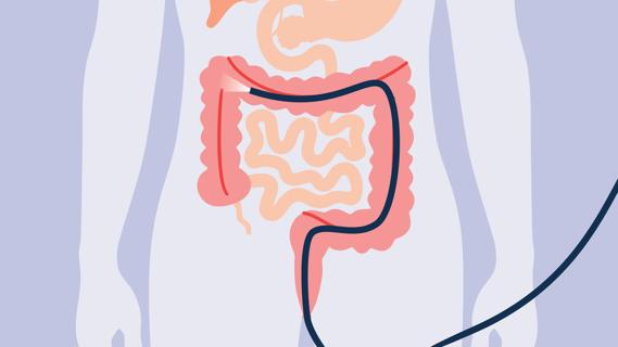 A male body receiving a colon cancer screening with a colonoscope