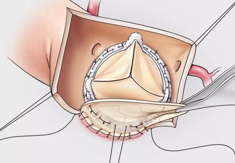 21-HVI-2061012-surgical-aortic-valve-replacement_650x450