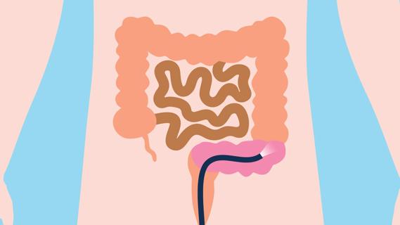 Sigmoidoscopy, with scope inside rectum