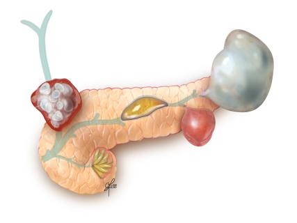 Pancreatic cysts
