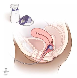 Fecal incontinence pessary