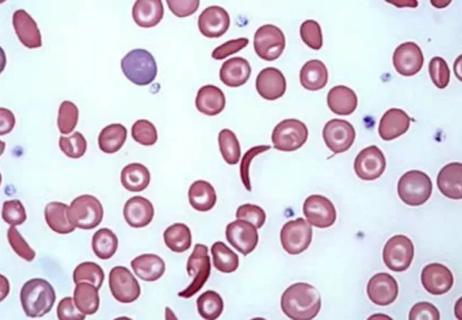 650&#215;450-Sickle Cell Trait