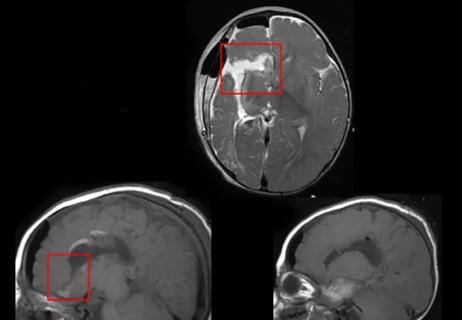 21-NEU-2536041-disconnective-hemispherectomy-650&#215;450