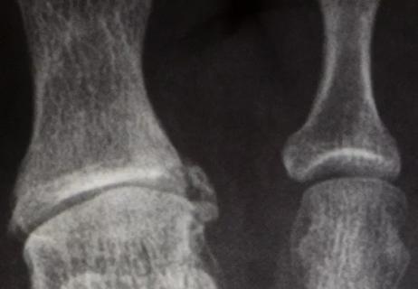 Stepping on Toes: Is Cheilectomy Better than Arthrodesis for Mild-to-Moderate Hallux Rigidus?