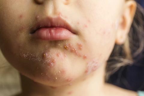 Measles