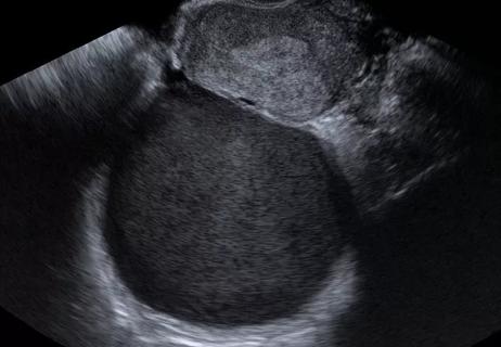 endometrioma_650x450