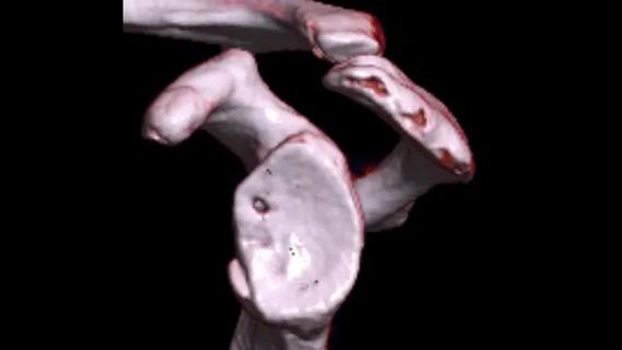 CT image demonstrating glenoid bone loss