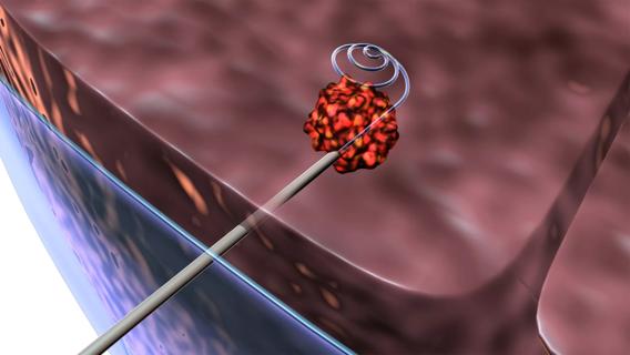 Lung microcoil Cleveland Clinic