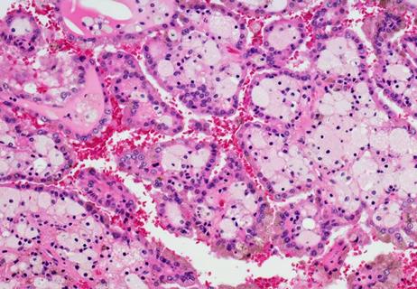 650&#215;450-Renal-Cell-Carcinoma