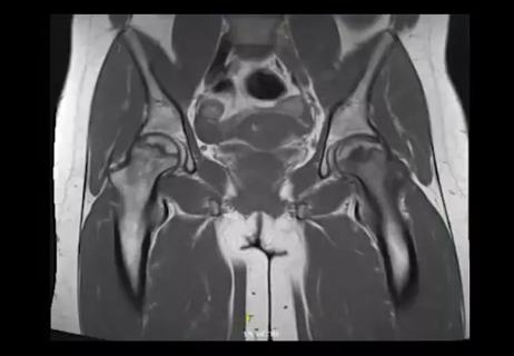 21-RHE-2528452-Patient-with-Steroid-Toxicity-CQD_650x450