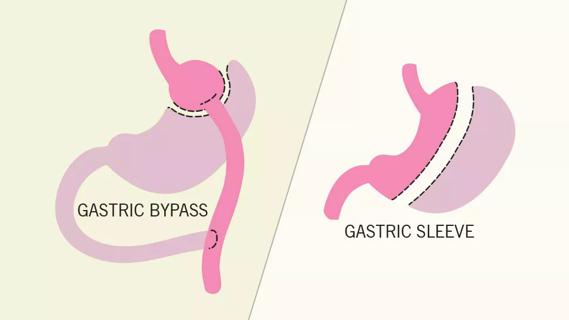 Two bariatric surgery options: grastric bypass and gastric sleeve