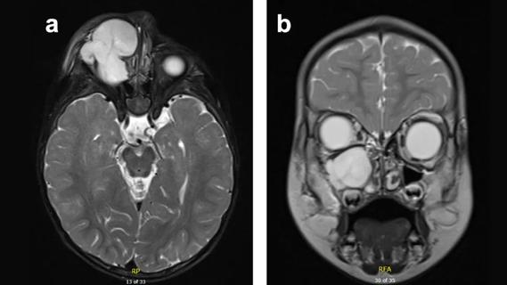 T2 Magnetic Resonance Imaging (MRI) of maxillary sinus mass with extraconal intraorbital extension