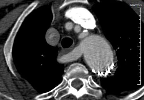 22-HVI-2977158_aberrant-right-subclavian-artery_650x450