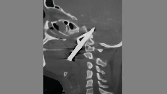 CT scan showing a sharp object penetrating a human brain