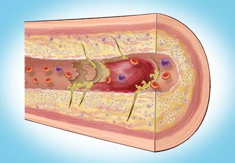 Semaglutide Shows Secondary Cardiovascular Prevention Benefits in Patients  Without Diabetes