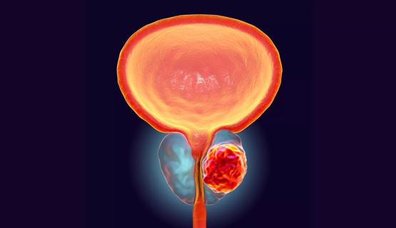 Prostate cancer