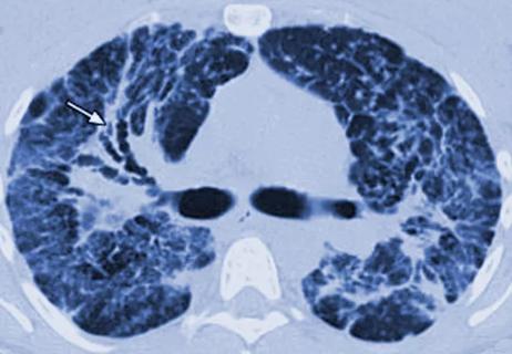 Imaging in sarcoidosis