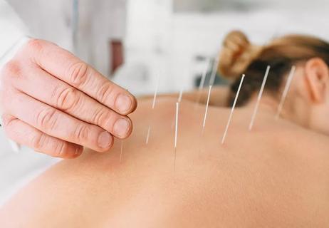 person lying on their stomach with many small needles in their back