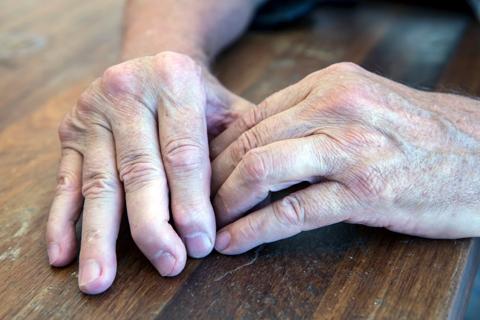 Hands bent from arthritis