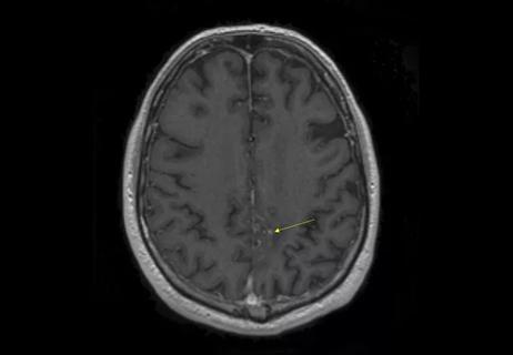 18-NEU-4010-glioblastoma-laser-ablation-650&#215;450