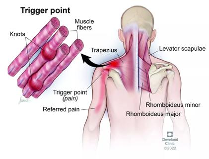 myofascial pain syndrome