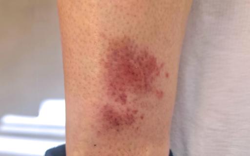 Red, patchy rash, vasculitis, on skin