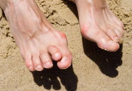 When Should You Consider Surgery for a Bunion or Hammertoe? - Keck Medicine  of USC