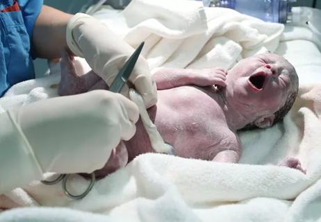 A healthcare provider clamps the umbilical cord of a neonate immediately following birth