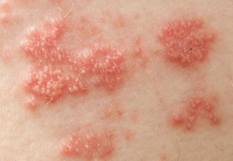 shingles virus on skin