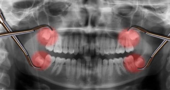 X-ray of teeth, with wisom teeth highlighted red, with dental tools on top of X-ray