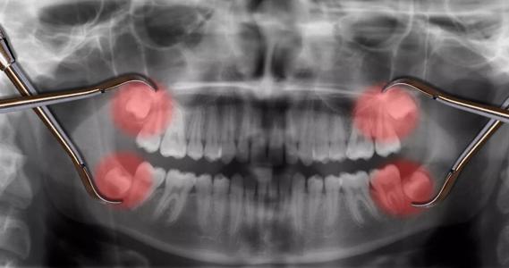 Do You Have to Remove Your Wisdom Teeth? Tips for Care