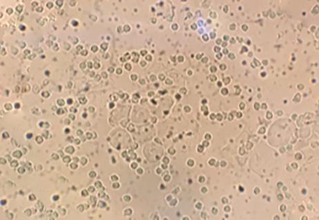 19-OBG-1085_650x450_desquamative inflammatory vaginitis