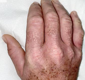 waxy papules on his hands, with associated skin thickening and finger flexion contractures on hand