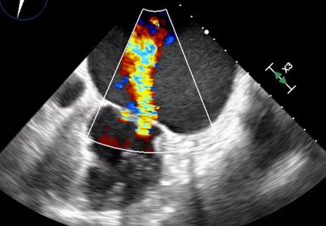 echocardiogram image with an outlined slice emphasizing a colored section