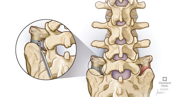 illustration of lumbar spine with inset showing area of defect