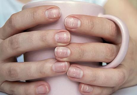 A close-up of someone's hands as they hold a coffee mug, their fingernails streaked with white spots.