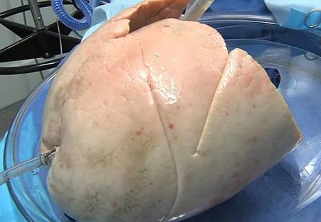 Ex vivo lung perfusion