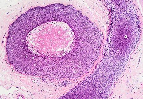 21-CNR-2544358-CQD-Hero-650&#215;450 DCIS biosignature