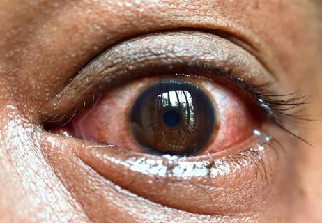 Closeup of irritated eye showing redness with blood vessels in eye.