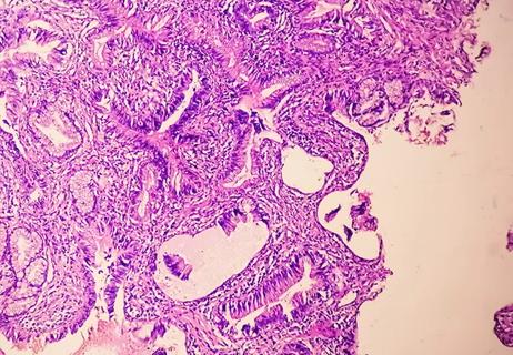 Microscopic image showing adenocarcinoma of Prostate.
