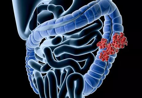 young-onset colorectal cancer