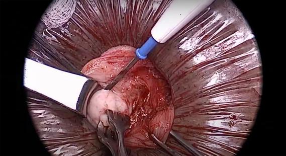 image from mini-laparotomy