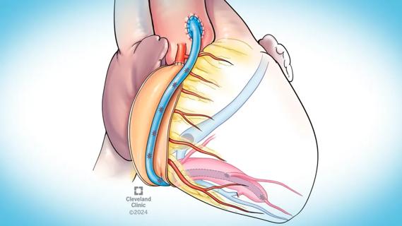 illustrated heart with a graft and visible blood vessels